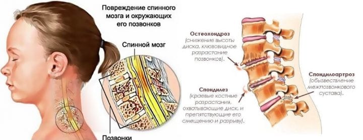Zervikale Osteochondrose Zervikale Osteochondrose